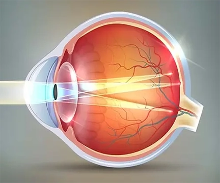 Diagram of Astigmatism in the inner-eye