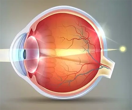 Diagram of Hyperopia in the inner-eye