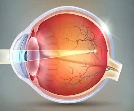 Diagram of Myopia in the inner-eye